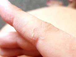 Правда ли, что у школьников в Анапе от антисептика разъедает кожу на руках?