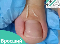 Вросший ноготь на ноге – это и боль, и неудобство при ношении обуви, и ограничения в движениях