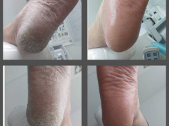 Трещины на пятках? Не проблема!