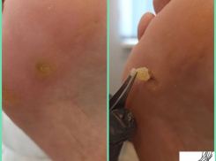 Стрежневая мозоль – маленькая, но болезненная