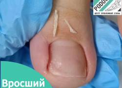 Вросший ноготь на ноге – это и боль, и неудобство при ношении обуви, и ограничения в движениях