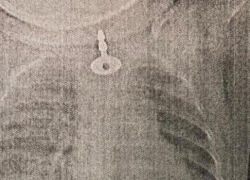 В соседнем с Анапой городе врачи спасли 11-месячную девочку. Она проглотила металлический ключ