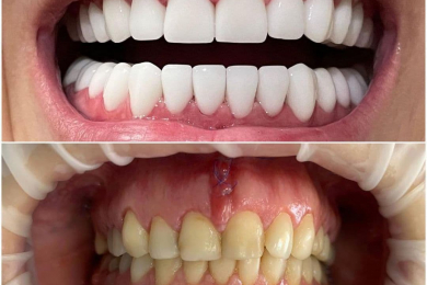 Протезирование зубов в клинике «Ваша стоматология» - 