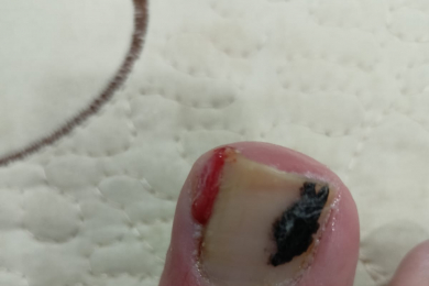 Медицинский педикюр - 