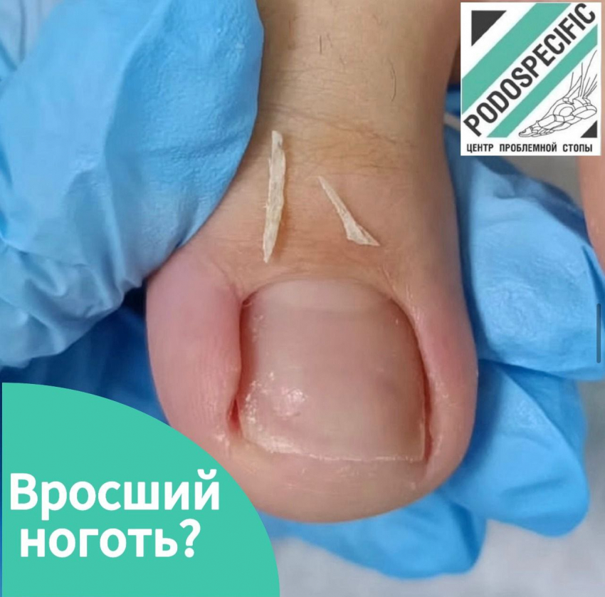 Вросший ноготь на ноге – это и боль, и неудобство при ношении обуви, и ограничения в движениях